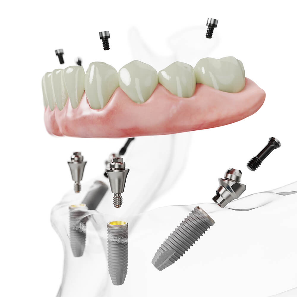 All on 4 全口重建