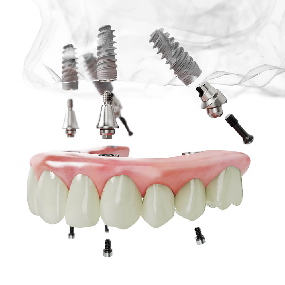 All on 4 全口重建