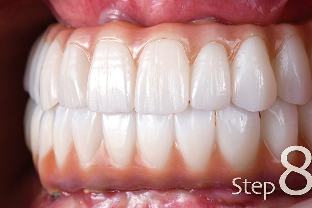 法夏爾來看牙 Allon4手術當天流程 工作區域 1 複本 10