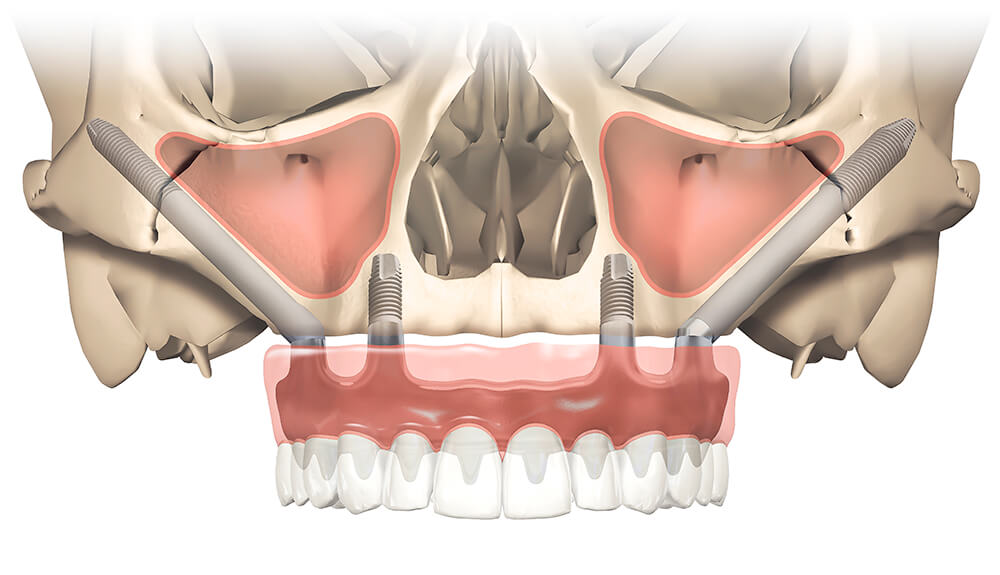 All-on-4 失敗代價