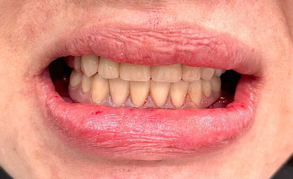 全口重建傷口腫痛