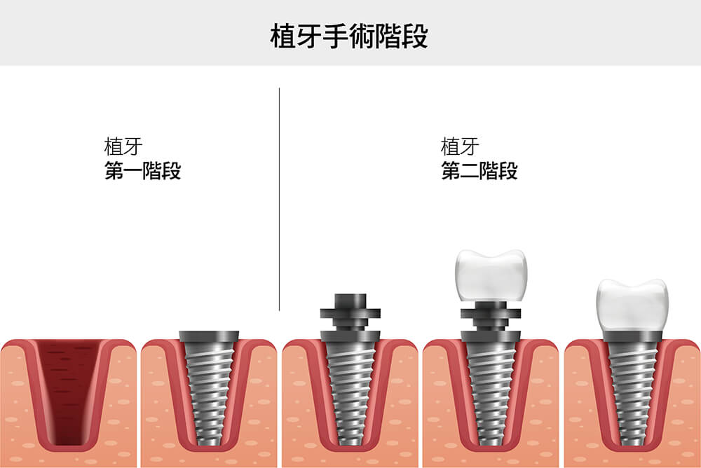 數位植牙手術流程 工作區域 1 複本 6