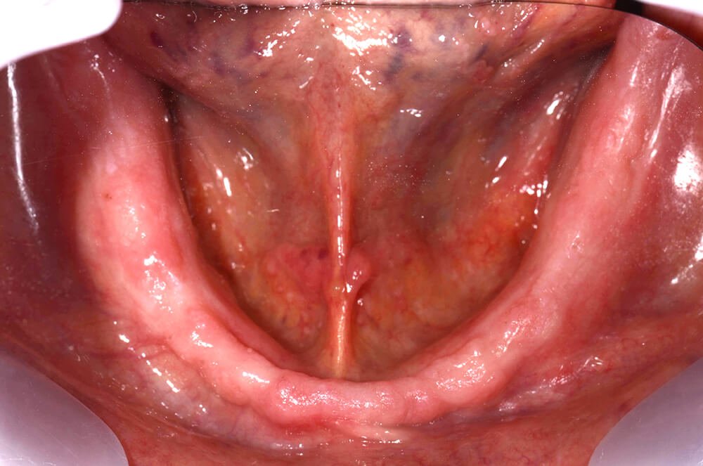 全口缺牙一定要馬上處理嗎