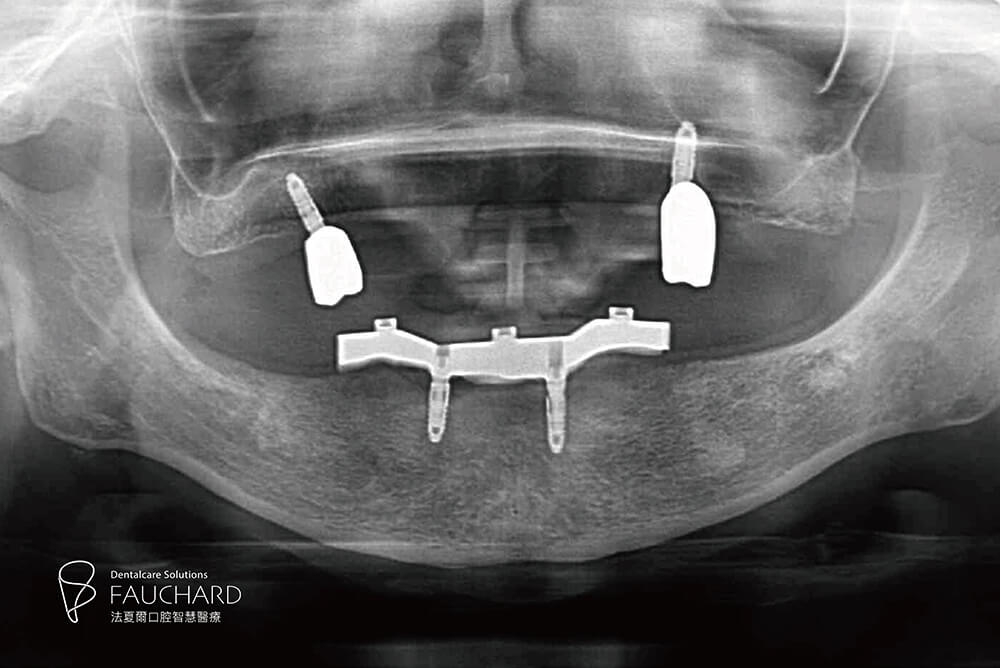 全口缺牙一定要馬上處理嗎