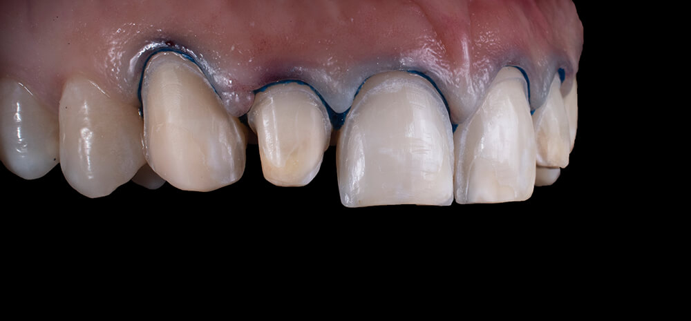 6.牙醫師顯微修磨