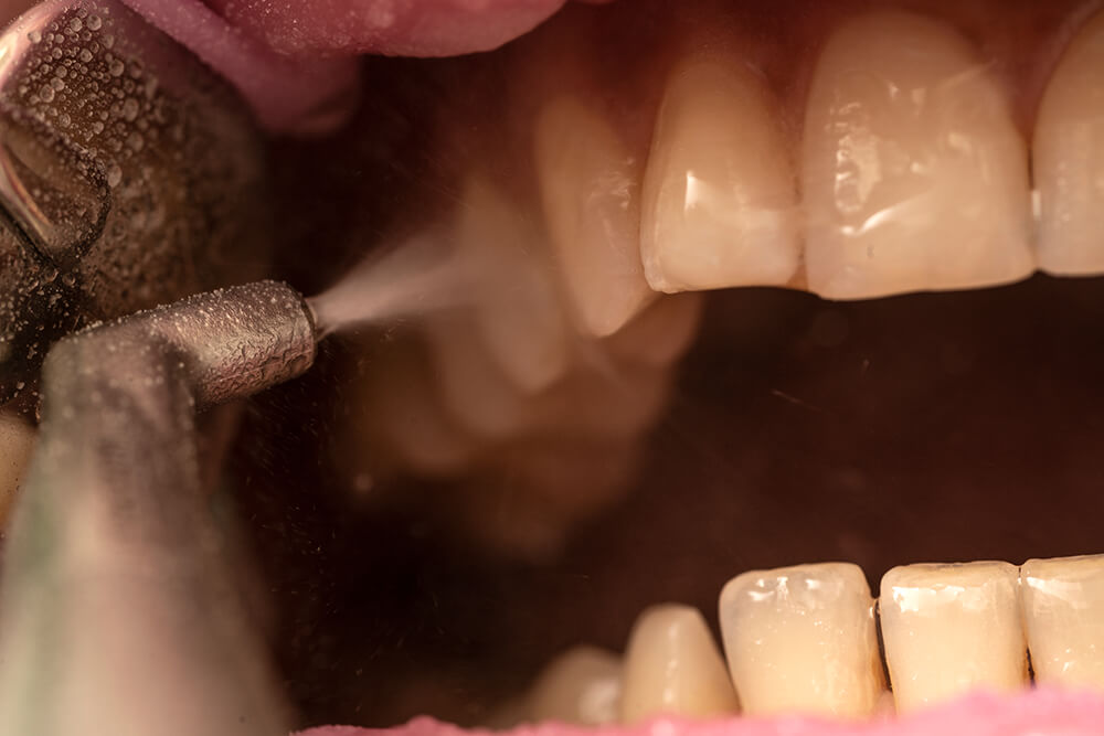 牙齒噴砂會傷牙齒嗎?