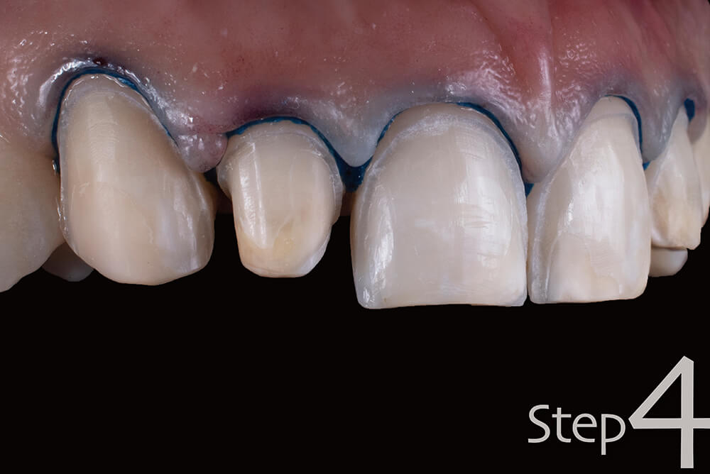 陶瓷貼片流程 4 2