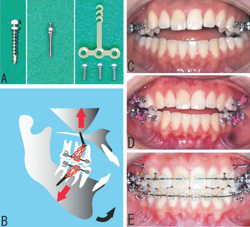 tooth bon nail style